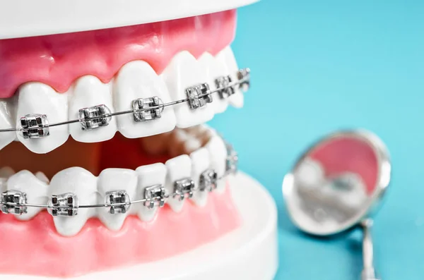 Modelo Dientes Cerca Con Abrazaderas Dentales Alambre Metálico Equipo Dental — Foto de Stock