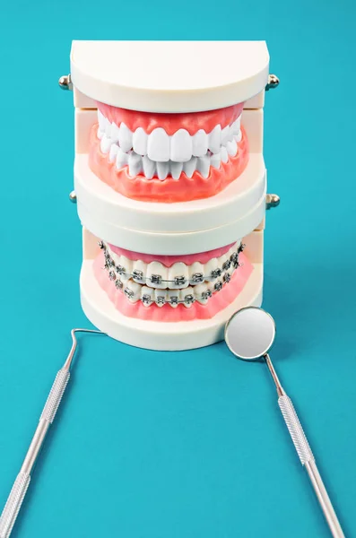 Porównaj Modele Zębów Zębów Metalowymi Drucianymi Aparatami Stomatologicznymi Sprzętem Niebieskim — Zdjęcie stockowe