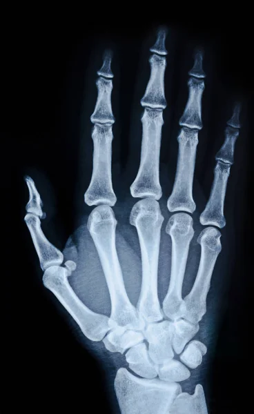 Immagine a raggi X della mano . — Foto Stock
