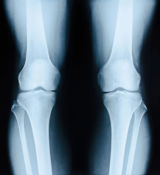 Paziente immagine a raggi X con cambiamento degenerativo dell'articolazione del ginocchio . — Foto Stock