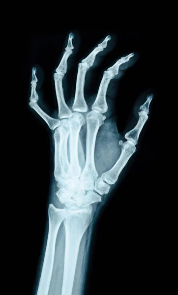 Imagen de rayos X de la mano . — Foto de Stock