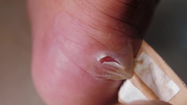 Unstick adhesive plaster from heel, take off bandage patch from callus on leg — Stock Video