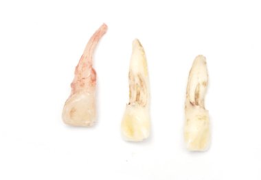 süt diş, bebek dişi veya primer diş, izole kaybetme 