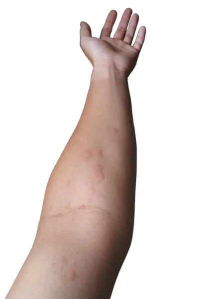 Hautausschlag Arm Auf Weißem Hintergrund — Stockfoto