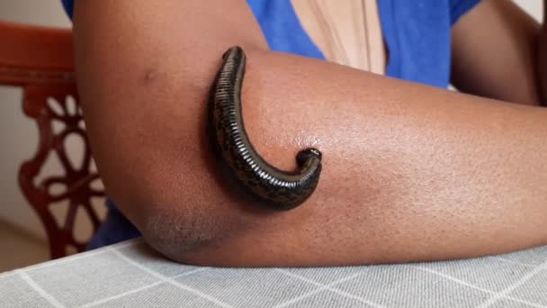 Θεραπεία Αγκώνας Τένις Leech Therapy — Αρχείο Βίντεο