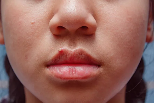 Young woman with pimples on face. — Stock Photo, Image