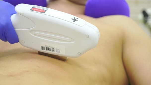 Manliga laser hårborttagning. en läkare i handskar avlägsnar hår från buken och brösten för en man. 4k, närbild. — Stockvideo