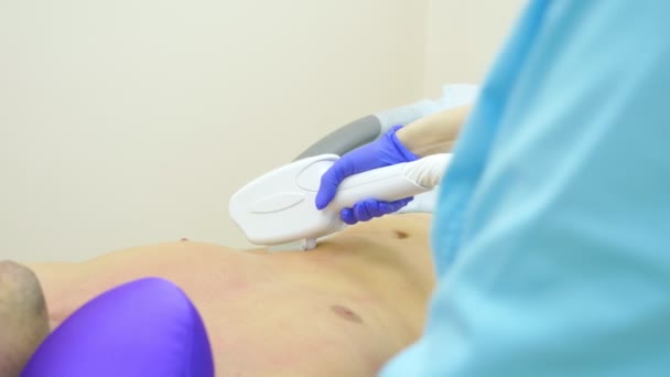Depilação a laser masculina. um médico em luvas remove o cabelo do abdômen e seios de um homem. 4k, close-up . — Vídeo de Stock