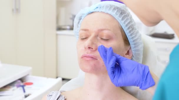 Les mains d'un chirurgien plastique dessinent des contours sur le visage des patients. 4k. pour la procédure de plastie du contour du visage . — Video