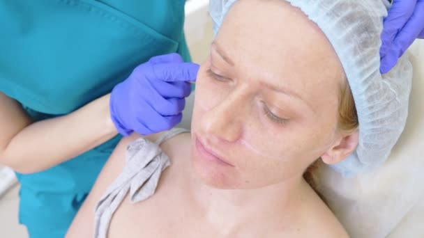 De handen van een plastisch chirurg tekenen contouren op het gezicht van de patiënten. 4 k. voor de procedure van contour plastie van het gezicht. — Stockvideo