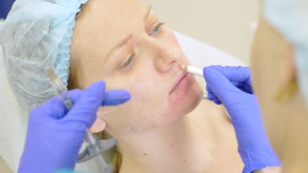 外科医の手は患者の顔に輪郭線を描画します。4 k. 顔の輪郭形成術の手順. — ストック動画