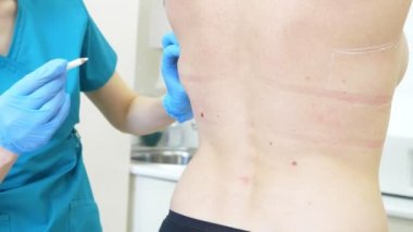 kalın kadın tıbbi liposuction için hazırlar. Doktor marker, arkadaki işareti çizer. 4k