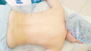 makyajcısı dermatolog Doktor şişman kıvrımları hasta kadının sırtında bir şırıngada aracılığıyla lipolitics tanıttı. 4k
