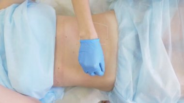 kalın kadın tıbbi liposuction için hazırlar. Doktor marker, karın üzerinde işareti çizer. 4k