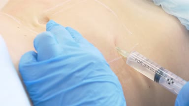 bir dermatolog-güzellik uzmanı Doktor lipolite bir şırınga ile hasta kadının mide yağ folds içine enjekte eder. 4k.