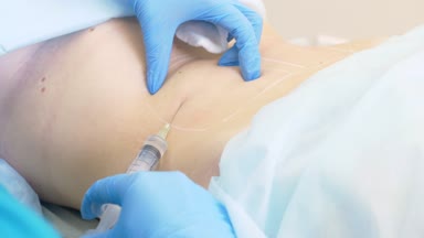 bir dermatolog-güzellik uzmanı Doktor lipolite bir şırınga ile hasta kadının mide yağ folds içine enjekte eder. 4k.