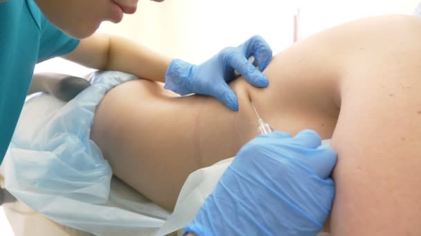 Врач-дерматолог косметолог вводит липолитику с помощью шприца в жировых складках на спине женщины пациента. 4k — стоковое видео