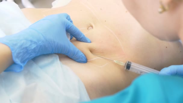 Ein Dermatologe-Kosmetologe Arzt spritzt Lipolit mit einer Spritze in die Fettfalten auf dem Bauch der Patientin. 4k. — Stockvideo