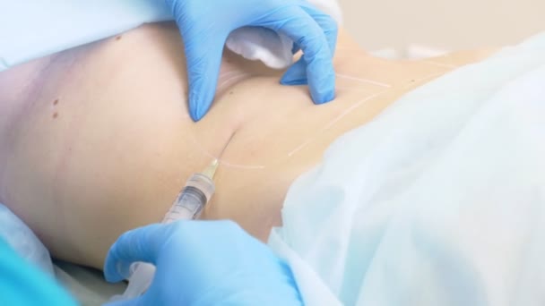 Ein Dermatologe-Kosmetologe Arzt spritzt Lipolit mit einer Spritze in die Fettfalten auf dem Bauch der Patientin. 4k. — Stockvideo