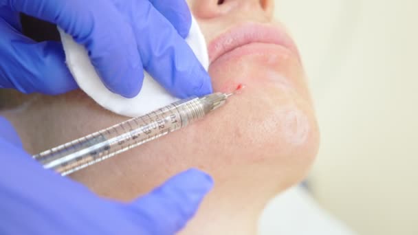 Läkare kosmetolog gör injektioner inför den kvinnliga tålmodig. begreppet skönhet och kosmetologi. 4 k. kontur plast — Stockvideo