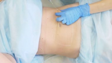 bir dermatolog-güzellik uzmanı Doktor lipolite bir şırınga ile hasta kadının mide yağ folds içine enjekte eder. 4k.
