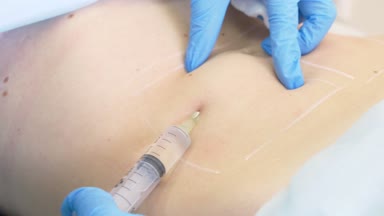 bir dermatolog-güzellik uzmanı Doktor lipolite bir şırınga ile hasta kadının mide yağ folds içine enjekte eder. 4k.