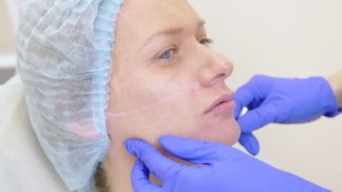 Bir plastik cerrahın elleri kontür hastalar yüzünde çizmek. 4 yüz kontur Plasti yordam için k..