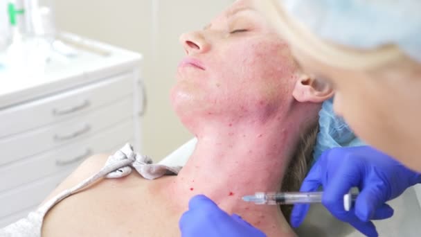 O médico esteticista faz injeções na cara do paciente feminino. conceito de beleza e cosmetologia. 4k . — Vídeo de Stock