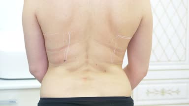 kalın kadın tıbbi liposuction için hazırlar. Doktor marker, arkadaki işareti çizer. 4k