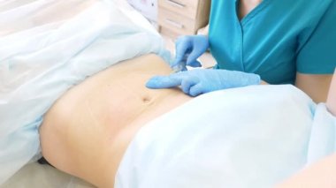 bir dermatolog-güzellik uzmanı Doktor lipolite bir şırınga ile hasta kadının mide yağ folds içine enjekte eder. 4k.
