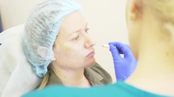 Las manos de un cirujano plástico dibujan contornos en la cara de los pacientes. 4k. para el procedimiento de plastia de contorno de la cara . — Vídeos de Stock