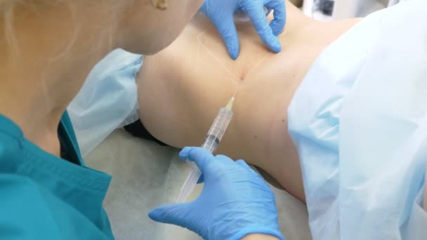 Ein Dermatologe-Kosmetologe Arzt spritzt Lipolit mit einer Spritze in die Fettfalten auf dem Bauch der Patientin. 4k. — Stockvideo