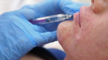 Doktor-güzellik uzmanı hasta dudakları artırmak için enjeksiyonları yapar. Güzellik ve kozmetik kavramı. 4k.