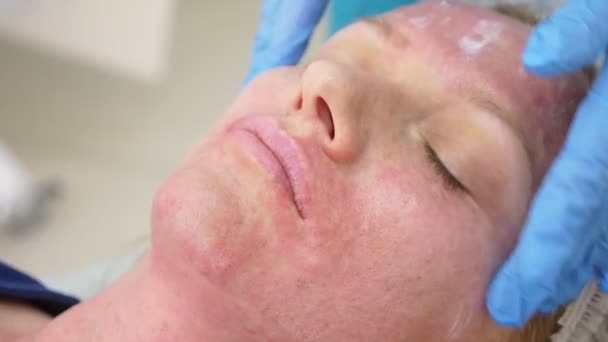 Врач-косметолог делает инъекции для увеличения губ пациента. концепция красоты и косметологии. 4k . — стоковое видео