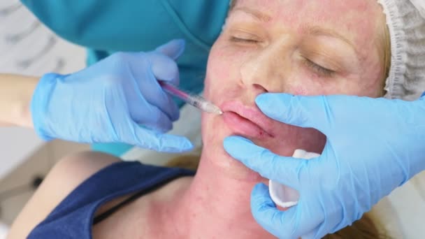 Az orvos-kozmetikus teszi injekciót, hogy növelje az ajkak, a beteg. koncepció, a szépség és kozmetika. 4k. — Stock videók