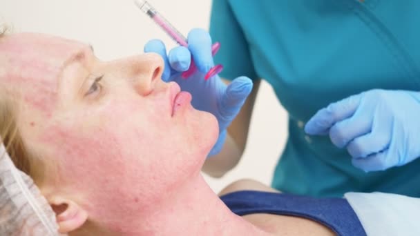 Dokter-ahli kosmetologi membuat suntikan untuk meningkatkan bibir pasien. konsep keindahan dan kosmologi. 4k . — Stok Video