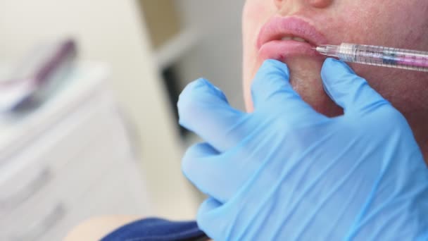 De arts-schoonheidsspecialist maakt injecties om de lippen van de patiënt. concept van schoonheid en cosmetologie. 4k. — Stockvideo