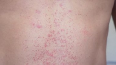 4k, bir adam çıplak bir gövde ile bir kırmızı döküntü karnına çizikler. Ağır çekim