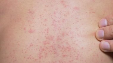 4k, bir adam çıplak bir gövde ile bir kırmızı döküntü karnına çizikler. Ağır çekim.