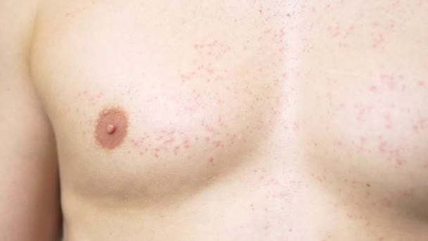 Hombre Con Torso Desnudo Rasca Una Erupción Roja Estómago Movimiento — Vídeo de stock