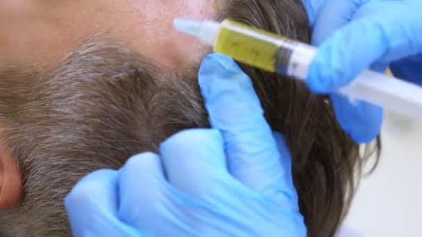 O procedimento de cosmetologia e centrífuga para o plasmolifting é um braço que faz injeções de plasma no couro cabeludo de um homem. 4K, câmara lenta. plasmolifting do couro cabeludo — Vídeo de Stock