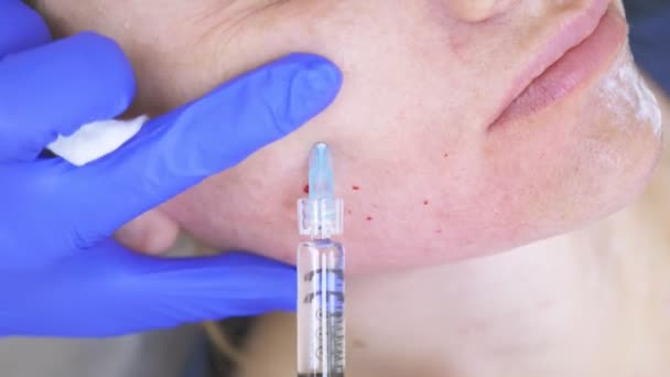 El médico esteticista hace inyecciones en la cara de la paciente femenina. concepto de belleza y cosmetología. 4k . — Vídeo de stock