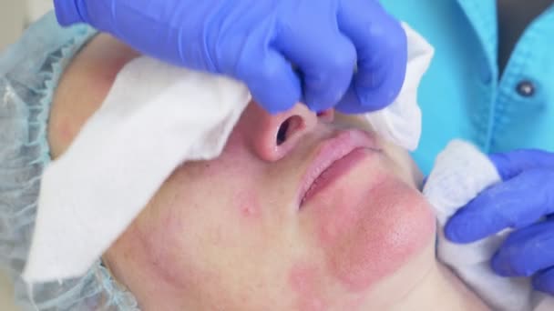 Procedure voor het reinigen van het gezicht in het kantoor van de artsen van een dermatoloog. 4 k, close-up, slow-motion. Knijpen de besmette pustulous acne om inoculatie — Stockvideo