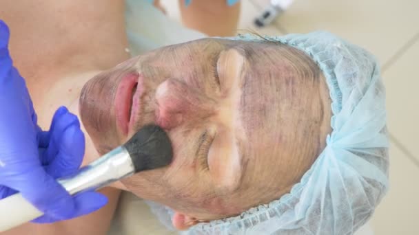 Soin du visage carbone. Les impulsions laser nettoient la peau du visage. Matériel traitement de cosmétologie. Peeling au carbone. Gros plan. Mouvement lent — Video