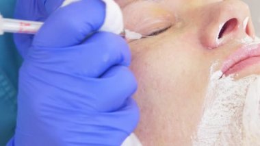 bir dermatolog doktor ofisinde yüz temizliği için yordam. 4 k, yakın çekim, ağır çekim. Aşılama için virüslü Püstüllü sivilce sıkma