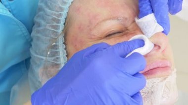 bir dermatolog doktor ofisinde yüz temizliği için yordam. 4 k, yakın çekim, ağır çekim. Aşılama için virüslü Püstüllü sivilce sıkma