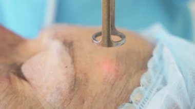 Karbon yüz tedavi. Lazer bakliyat yüz cilt temizlemek. Donanım Kozmetik tedavi. karbon peeling. yakın çekim. süper ağır çekim