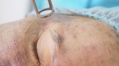 Karbon yüz tedavi. Lazer bakliyat yüz cilt temizlemek. Donanım Kozmetik tedavi. karbon peeling. yakın çekim. süper ağır çekim