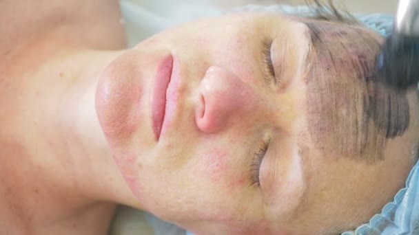 Soin du visage carbone. Les impulsions laser nettoient la peau du visage. Matériel traitement de cosmétologie. Peeling au carbone. Gros plan. super ralenti — Video