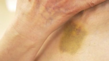 boyun ve bir kadının göğsünde çürükler. 4k, yakın çekim